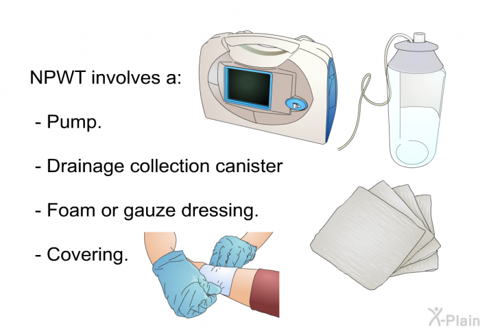 NPWT involves a:  Pump. Drainage collection canister Foam or gauze dressing. Covering.