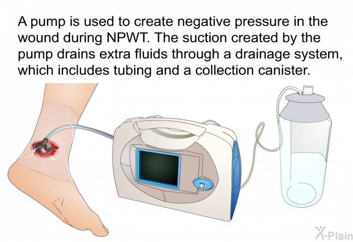 A pump is used to creative negative pressure in the wound during NPWT. The suction created by the pump drains extra fluids through a drainage system, which includes tubing and a collection canister.