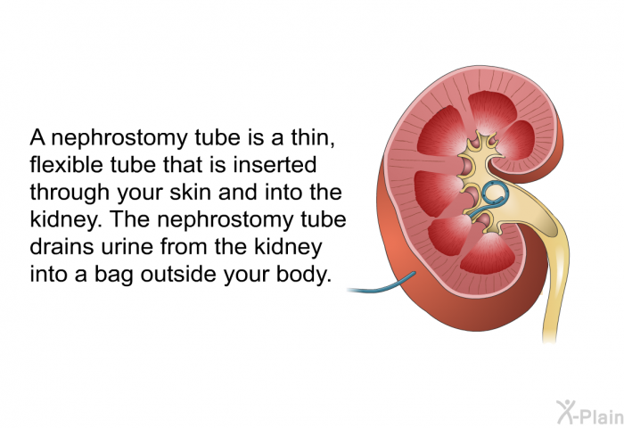 A nephrostomy tube is a thin, flexible tube that is inserted through your skin and into the kidney. The nephrostomy tube drains urine from the kidney into a bag outside your body.