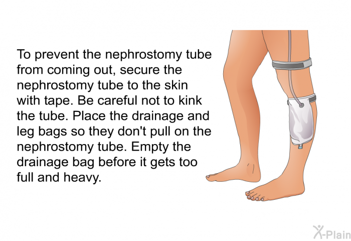 To prevent the nephrostomy tube from coming out, secure the nephrostomy tube to the skin with tape. Be careful not to kink the tube. Place the drainage and leg bags so they don't pull on the nephrostomy tube. Empty the drainage bag before it gets too full and heavy.