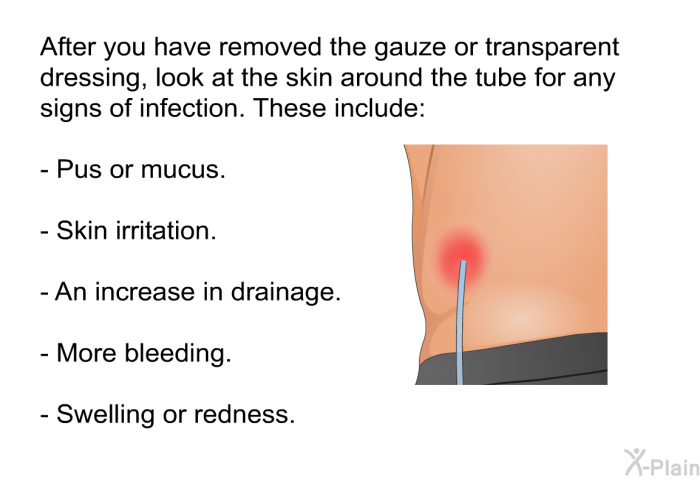 After you have removed the gauze or transparent dressing, look at the skin around the tube for any signs of infection. These include:  Pus or mucus. Skin irritation. An increase in drainage. More bleeding. Swelling or redness.