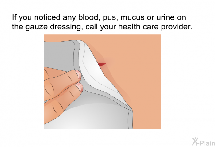 If you noticed any blood, pus, mucus or urine on the gauze dressing, call your health care provider.