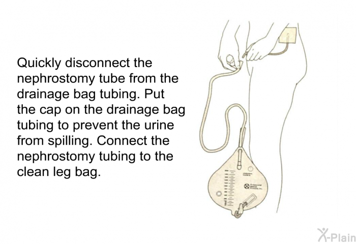 Quickly disconnect the nephrostomy tube from the drainage bag tubing. Put the cap on the drainage bag tubing to prevent the urine from spilling. Connect the nephrostomy tubing to the clean leg bag.