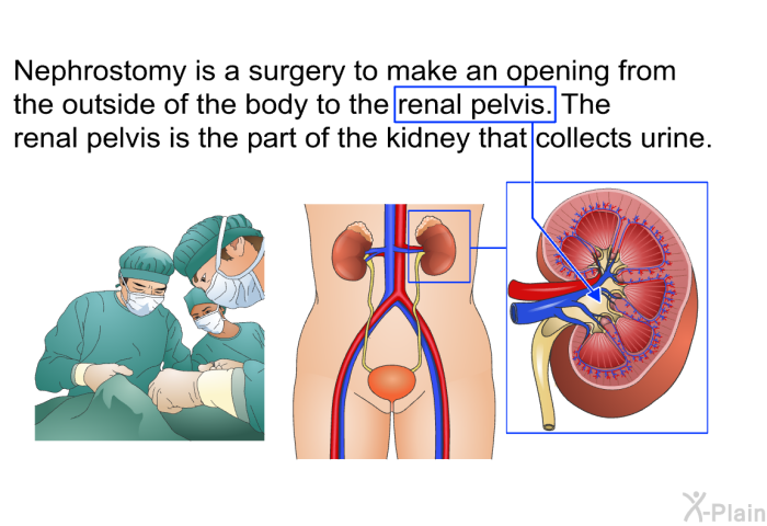 Nephrostomy is a surgery to make an opening from the outside of the body to the renal pelvis. The renal pelvis is the part of the kidney that collects urine.
