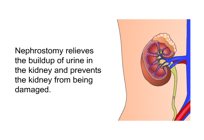 Nephrostomy relieves the buildup of urine in the kidney and prevents the kidney from being damaged.