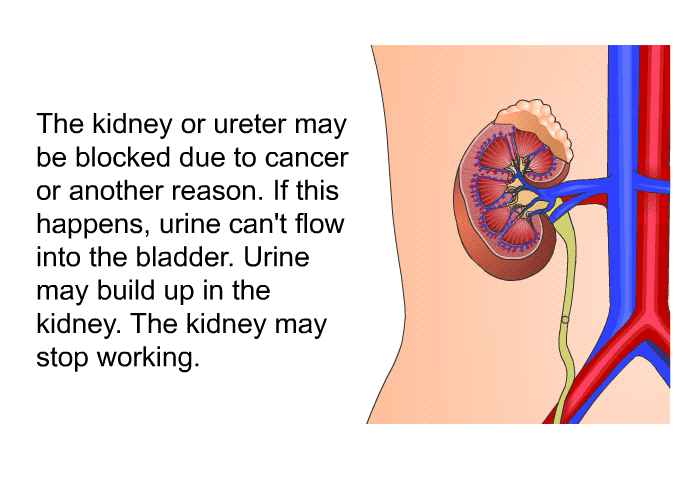 The kidney or ureter may be blocked due to cancer or another reason. If this happens, urine can't flow into the bladder. Urine may build up in the kidney. The kidney may stop working.
