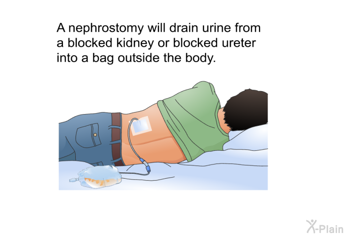 A nephrostomy will drain urine from a blocked kidney or blocked ureter into a bag outside the body.