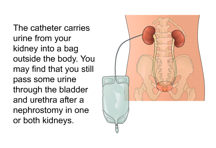 The catheter carries urine from your kidney into a bag outside the body. You may find that you still pass some urine through the bladder and urethra after a nephrostomy in one or both kidneys.