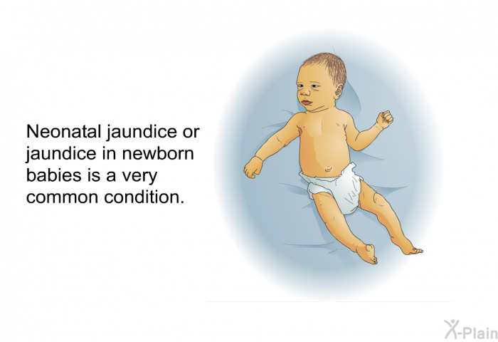 Neonatal jaundice or jaundice in newborn babies is a very common condition.