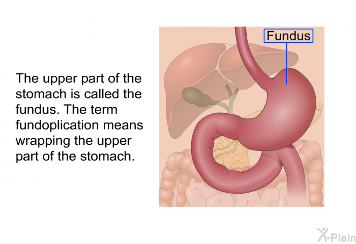 The upper part of the stomach is called the fundus. The term fundoplication means wrapping the upper part of the stomach.