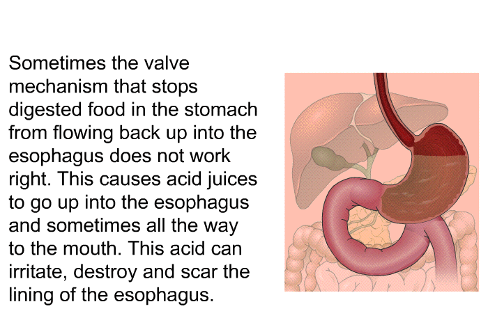 Sometimes the valve mechanism that stops digested food in the stomach from flowing back up into the esophagus does not work right. This causes acid juices to go up into the esophagus and sometimes all the way to the mouth. This acid can irritate, destroy and scar the lining of the esophagus.