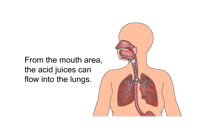 From the mouth area, the acid juices can flow into the lungs.