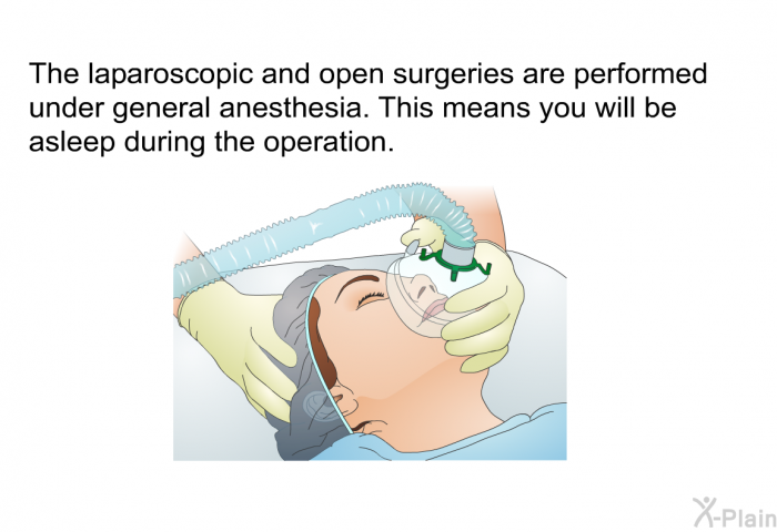 The laparoscopic and open surgeries are performed under general anesthesia. This means you will be asleep during the operation.