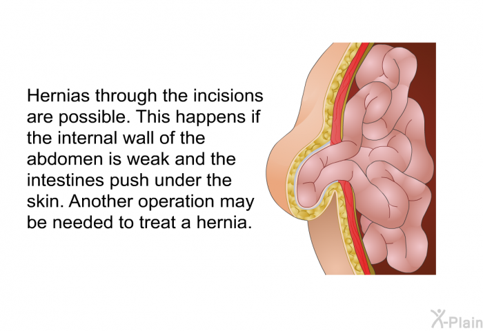 Hernias through the incisions are possible. This happens if the internal wall of the abdomen is weak and the intestines push under the skin. Another operation may be needed to treat a hernia.