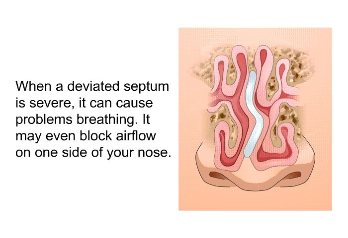 When a deviated septum is severe, it can cause problems breathing. It may even block airflow on one side of your nose.
