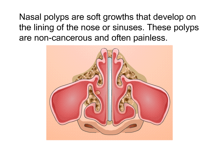 Nasal polyps are soft growths that develop on the lining of the nose or sinuses. These polyps are non-cancerous and often painless.