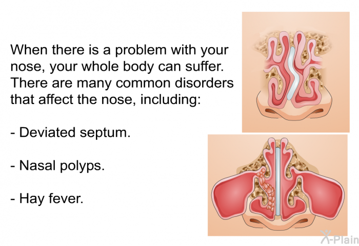 When there is a problem with your nose, your whole body can suffer. There are many common disorders that affect the nose, including:  Deviated septum. Nasal polyps. Hay fever.