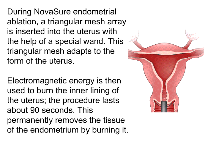 During NovaSure endometrial ablation, a triangular mesh array is inserted into the uterus with the help of a special wand. This triangular mesh adapts to the form of the uterus. Electromagnetic energy is then used to burn the inner lining of the uterus; the procedure lasts about 90 seconds. This permanently removes the tissue of the endometrium by burning it.