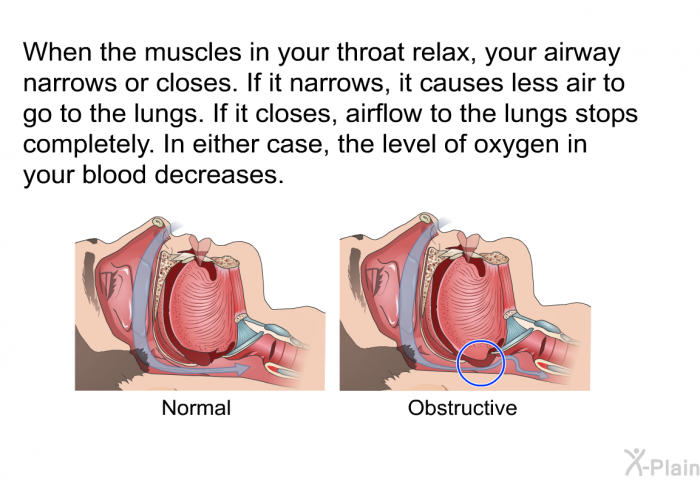 When the muscles in your throat relax, your airway narrows or closes. If it narrows, it causes less air to go to the lungs. If it closes, airflow to the lungs stops completely. In either case, the level of oxygen in your blood decreases.