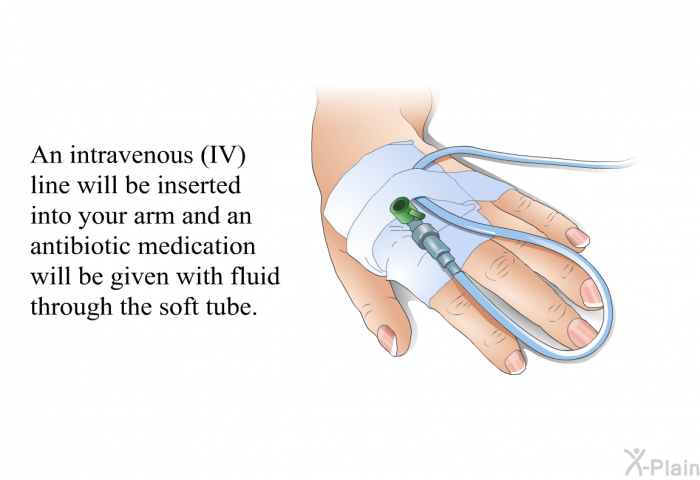An intravenous (IV) line will be inserted into your arm and an antibiotic medication will be given with fluid through the soft tube.
