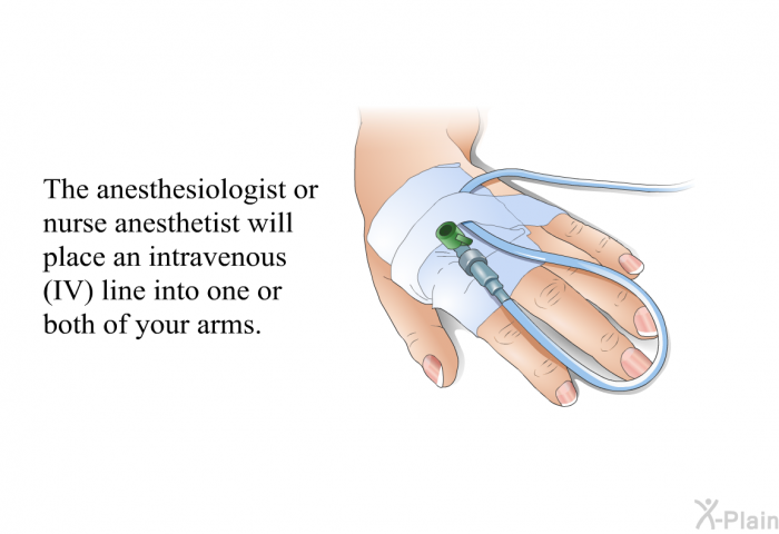 The anesthesiologist or nurse anesthetist will place an intravenous (IV) line into one or both of your arms.