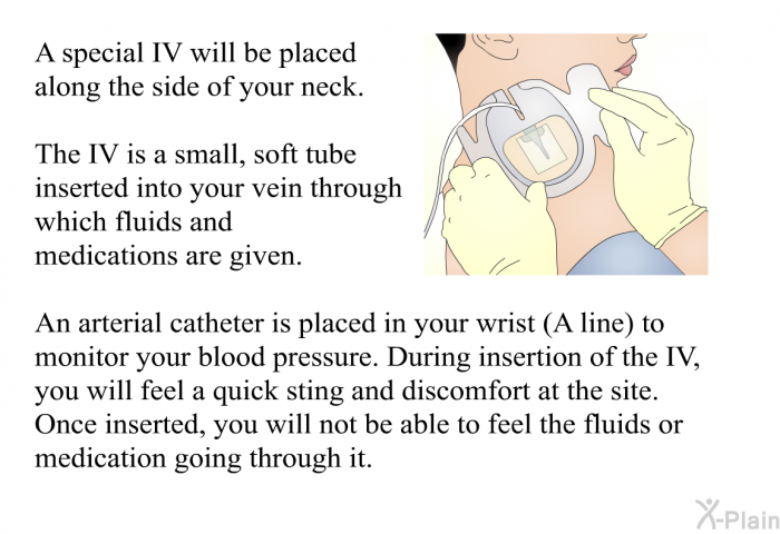 A special IV will be placed along the side of your neck. The IV is a small, soft tube inserted into your vein through which fluids and medications are given. An arterial catheter is placed in your wrist (A line) to monitor your blood pressure. During insertion of the IV, you will feel a quick sting and discomfort at the site. Once inserted, you will not be able to feel the fluids or medication going through it.