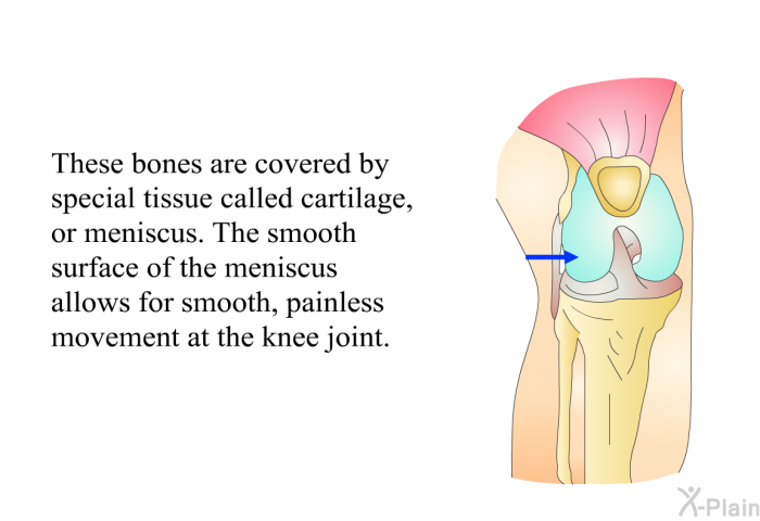 These bones are covered by special tissue called cartilage, or meniscus. The smooth surface of the meniscus allows for smooth, painless movement at the knee joint.