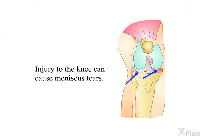 Injury to the knee can cause meniscus tears.