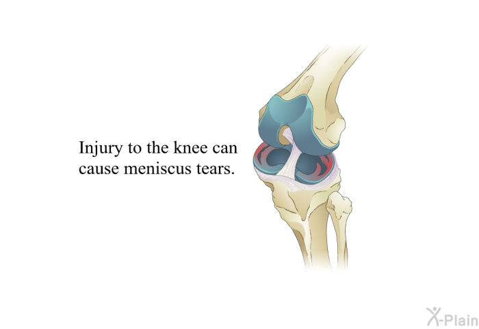 Injury to the knee can cause meniscus tears.