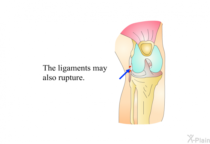 The ligaments may also rupture.