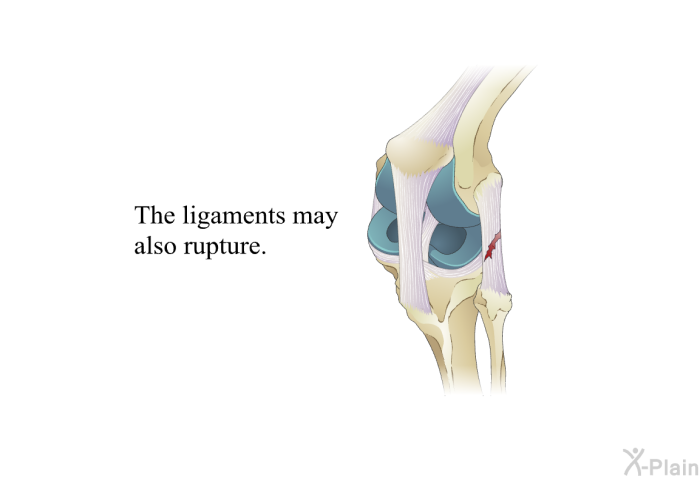 The ligaments may also rupture.