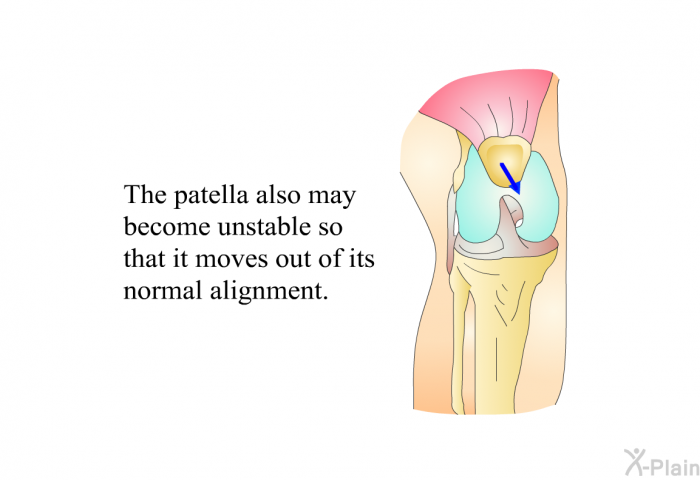 The patella also may become unstable so that it moves out of its normal alignment.
