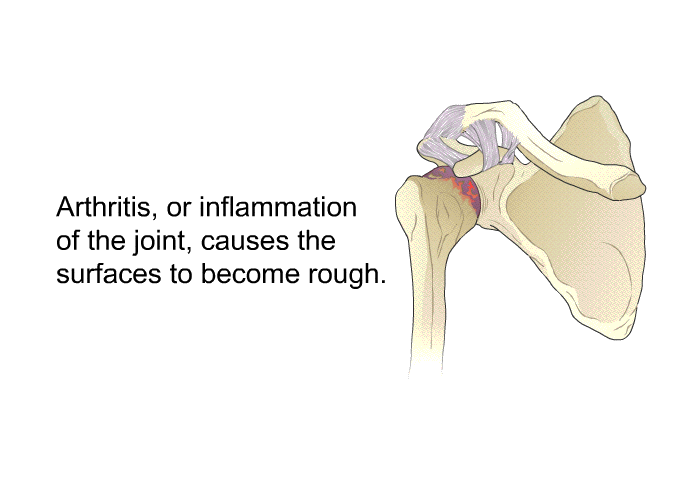 Arthritis, or inflammation of the joint, causes the surfaces to become rough.