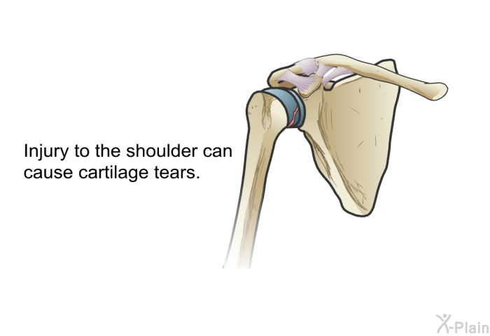 Injury to the shoulder can cause cartilage tears.
