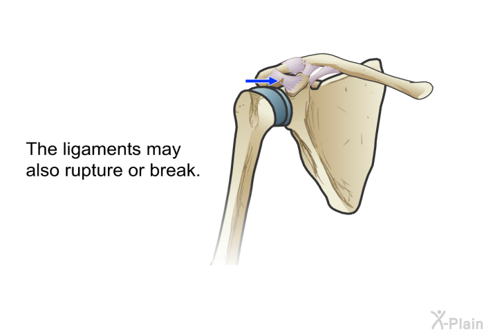 The ligaments may also rupture or break.