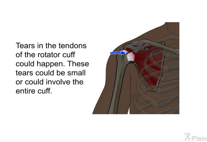 Tears in the tendons of the rotator cuff could happen. These tears could be small or could involve the entire cuff.