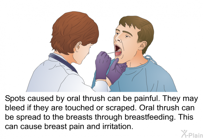 Spots caused by oral thrush can be painful. They may bleed if they are touched or scraped. Oral thrush can be spread to the breasts through breastfeeding. This can cause breast pain and irritation.