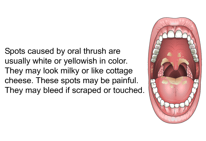 Spots caused by oral thrush are usually white or yellowish in color. They may look milky or like cottage cheese. These spots may be painful. They may bleed if scraped or touched.
