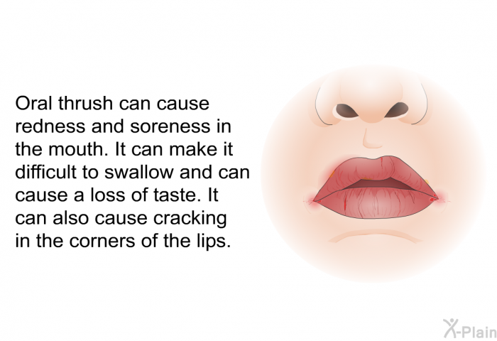 Oral thrush can cause redness and soreness in the mouth. It can make it difficult to swallow and can cause a loss of taste. It can also cause cracking in the corners of the lips.