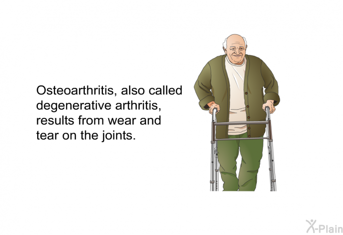 Osteoarthritis, also called degenerative arthritis<B>,</B> results from wear and tear on the joints.