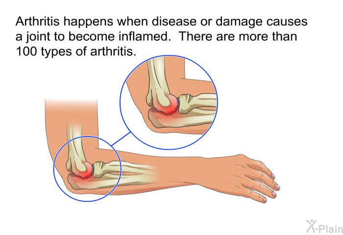 Arthritis happens when disease or damage causes a joint to become inflamed. There are more than 100 types of arthritis.