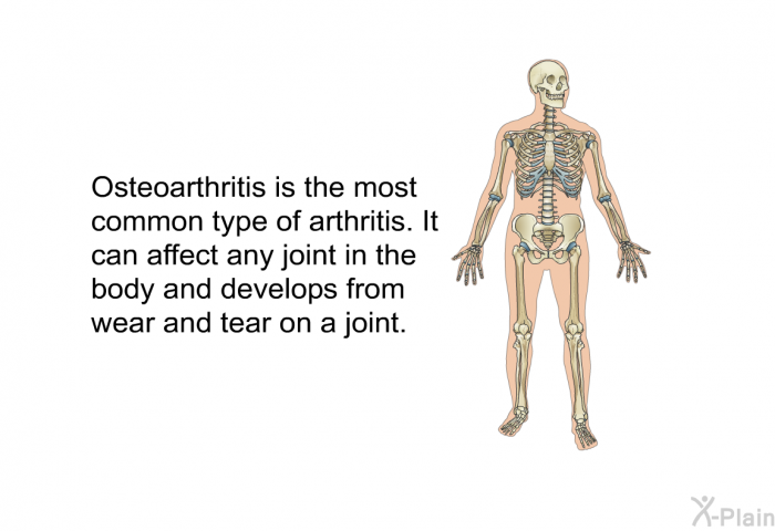 Osteoarthritis is the most common type of arthritis. It can affect any joint in the body and develops from wear and tear on a joint.
