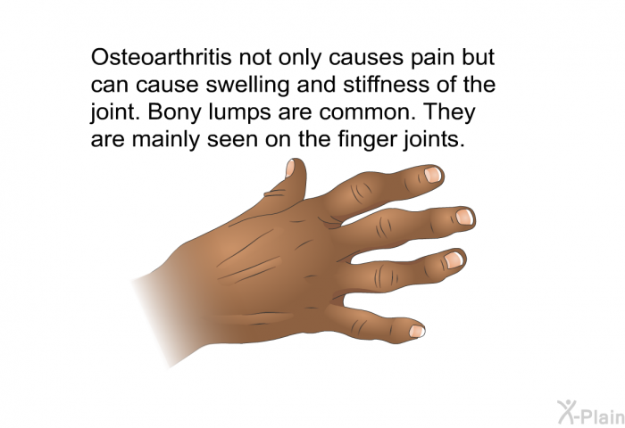 Osteoarthritis not only causes pain but can cause swelling and stiffness of the joint. Bony lumps are common. They are mainly seen on the finger joints.