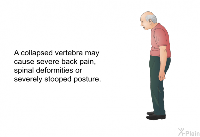 A collapsed vertebra may cause severe back pain, spinal deformities or severely stooped posture.