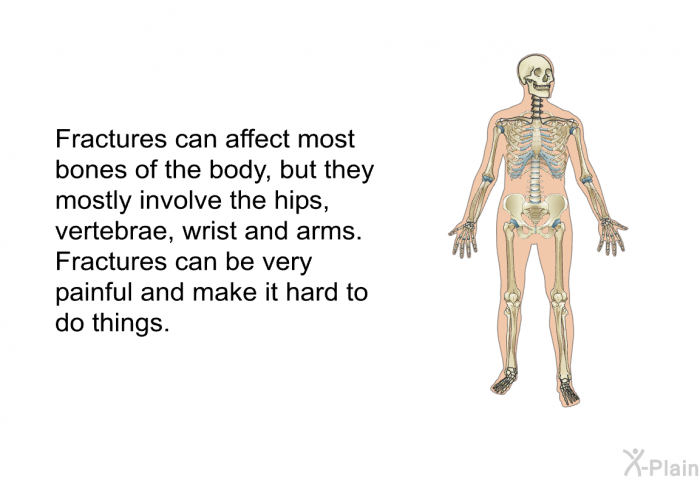 Fractures can affect most bones of the body, but they mostly involve the hips, vertebrae, wrist and arms. Fractures can be very painful and make it hard to do things.