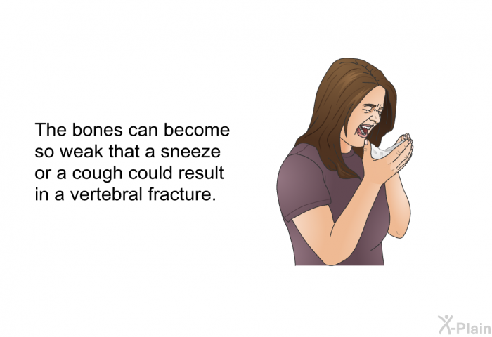 The bones can become so weak that a sneeze or a cough could result in a vertebral fracture.