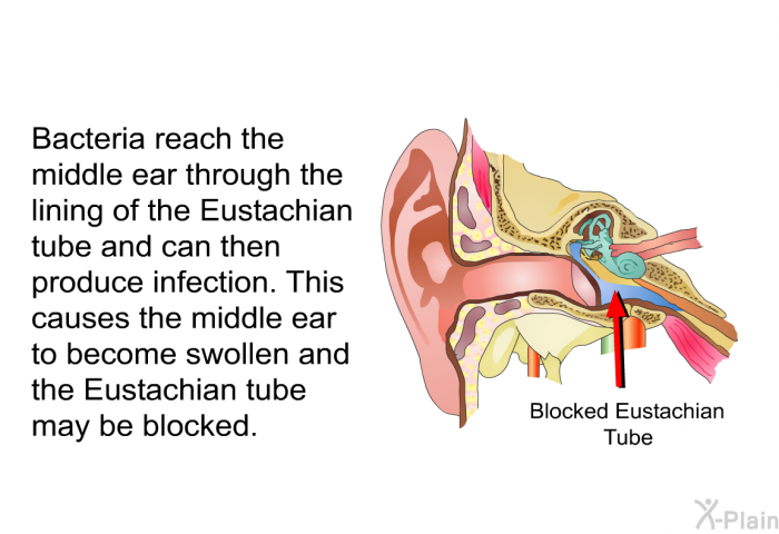 Bacteria reach the middle ear through the lining of the Eustachian tube and can then produce infection. This causes the middle ear to become swollen and the Eustachian tube may be blocked.