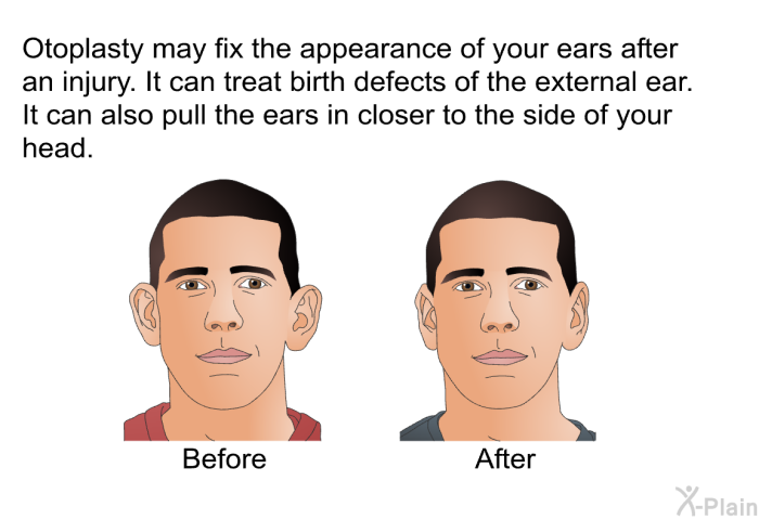 Otoplasty may fix the appearance of your ears after an injury. It can treat birth defects of the external ear. It can also pull the ears in closer to the side of your head.