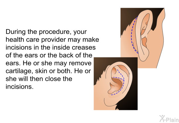 During the procedure, your health care provider may make incisions in the inside creases of the ears or the back of the ears. He or she may remove cartilage, skin or both. He or she will then close the incisions.