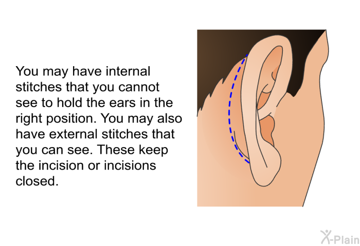 You may have internal stitches that you cannot see to hold the ears in the right position. You may also have external stitches that you can see. These keep the incision or incisions closed.
